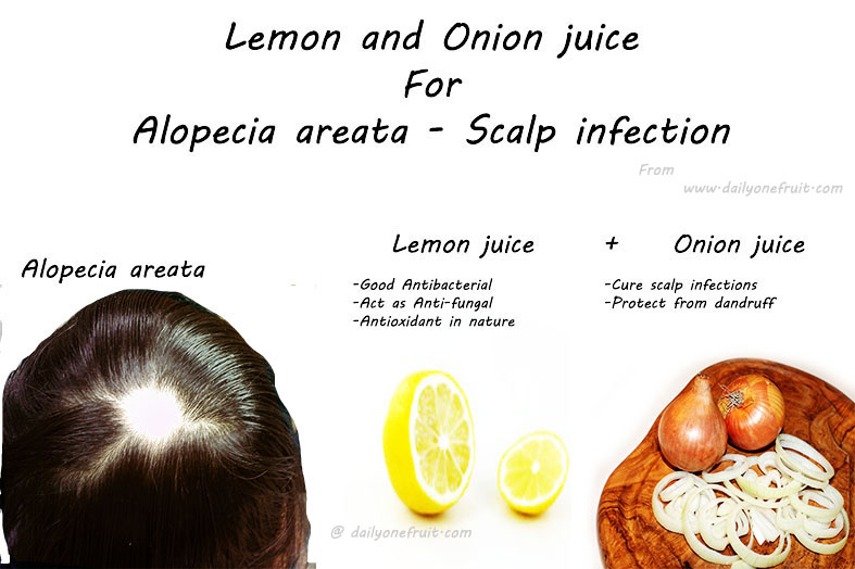 Onion and Lemon hair pack that cure Alopecia areata