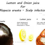 Onion and Lemon hair pack that cure Alopecia areata and scalp infections