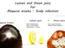 Onion and Lemon hair pack that cure Alopecia areata and scalp infections