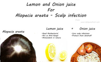 Onion and Lemon hair pack that cure Alopecia areata and scalp infections
